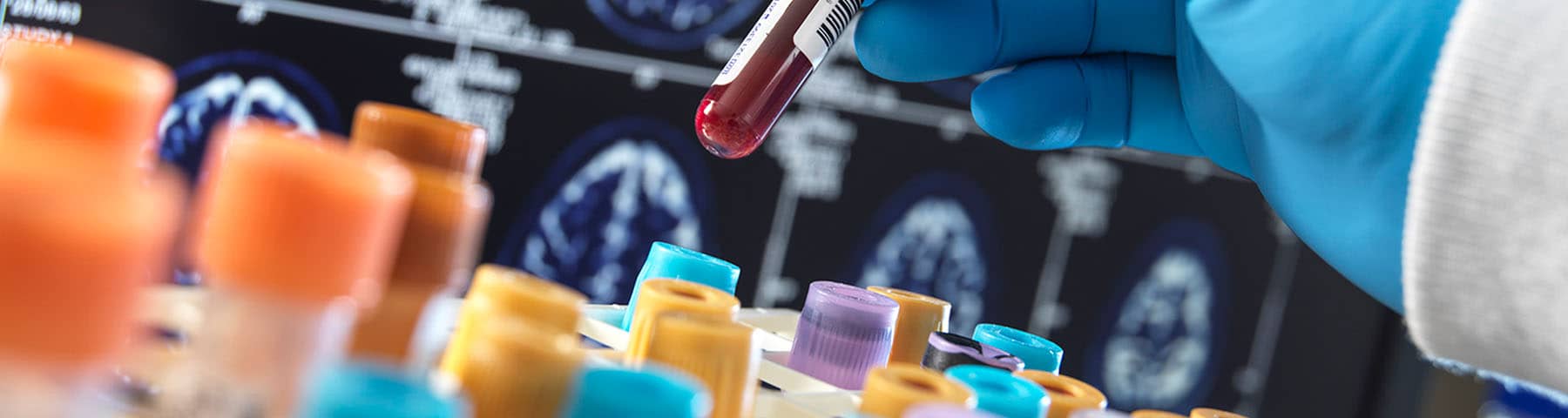 Gloved hand holding a blood sample vial with test tubes and brain scans in the background.