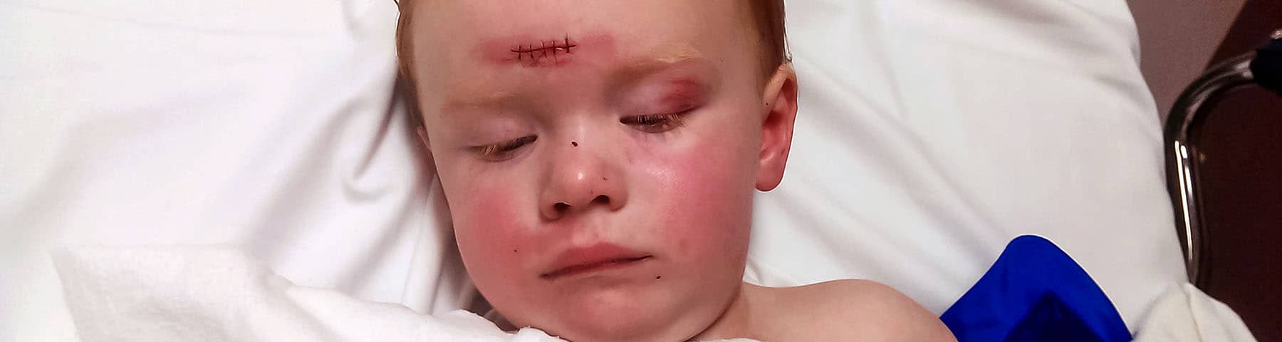 Young child resting in a hospital bed with stitches on their forehead.